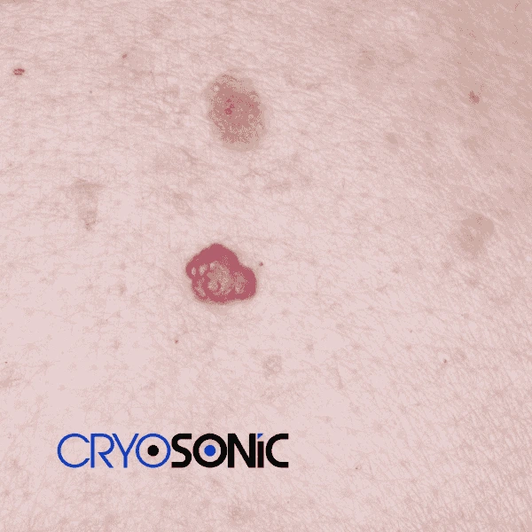 Looking for pain free cherry angioma removal treatment Yeovil? Call our team today! Yeovil