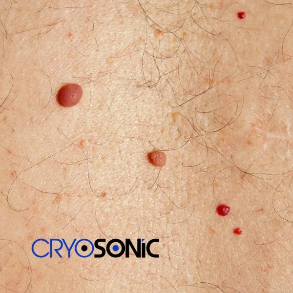 get cherry angioma removal treatment today! Yeovil
