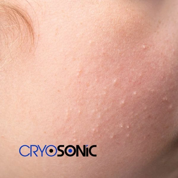 Are you looking for milia removal treatment? Contact our team today Yeovil