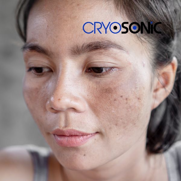 Ready to start age spots removal? Contact our team today in Yeovil