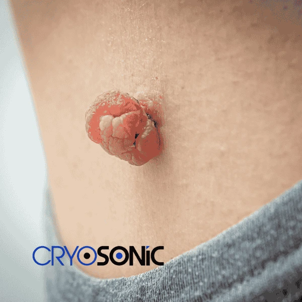 Book your skin tags removal Yeovil from comfort of your own home! Yeovil