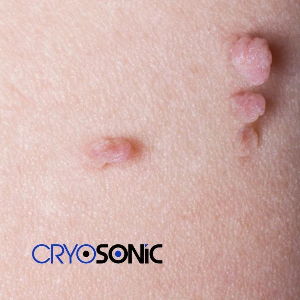 Are you looking for fast effect skin tag removal Yeovil? Book in NOW! Yeovil