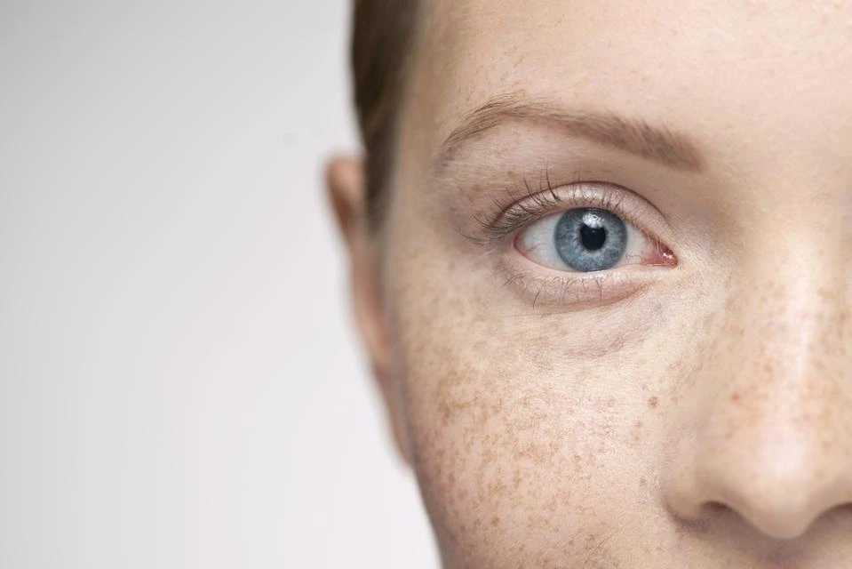 Understanding Sun Damage: How UV Rays Alter Skin and How CryoPen Can Reverse It Yeovil