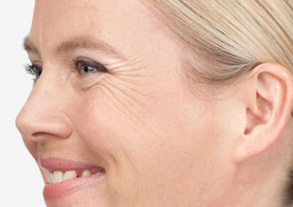 CryoPen Precision vs. Laser: Which Is Better for Sun-Damaged Skin? Yeovil