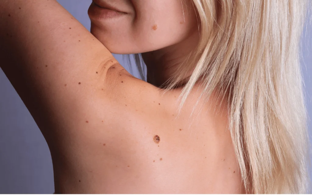 What Are Sun Spots and Pigmentation Yeovil? Yeovil