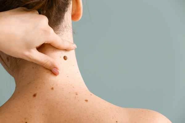 Who Should Avoid CryoPen Treatments? Yeovil