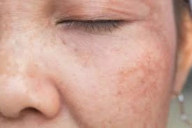 CryoPen Precision vs. Laser: Are Both Treatments Safe? Yeovil