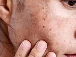 Why CryoPen Works Best for Isolated Sun Spots and Pigmentation Yeovil