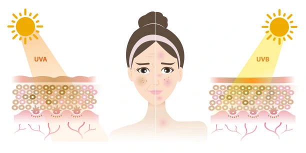Understanding Sun Damage Yeovil : How Do UV Rays Cause Changes in the Skin? Yeovil