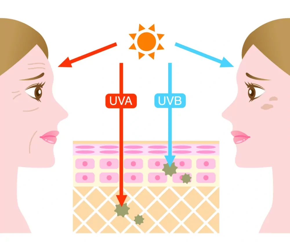 Understanding Sun Damage Yeovil - Why Should Sun Damage Be Treated Early? Yeovil